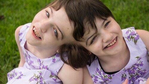 Inseparable: 10 Years Joined at the Head Inseparable: 10 Years Joined at the Head