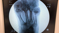 Little Toe Needs Help! Little Toe Needs Help!