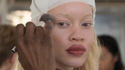 Albinism is just a colour