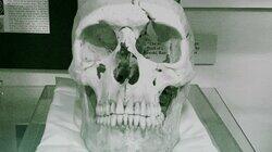 Phineas Gage's Skull Phineas Gage's Skull