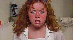 Sunburn Sunburn