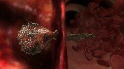 Worms Are Eating My Lungs Worms Are Eating My Lungs