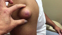 Tackling an Epidermoid Cyst Tackling an Epidermoid Cyst