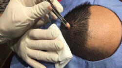 A Pilar Cyst and a Button Blackhead Are No Match for Dr. Pimple Popper A Pilar Cyst and a Button Blackhead Are No Match for Dr. Pimple Popper