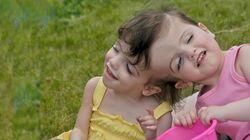 The Twins Who Share a Brain The Twins Who Share a Brain